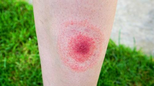 Lyme disease is caused by the bacterium Borre - Imagen 1